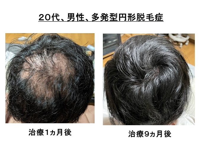 円形脱毛症　病院